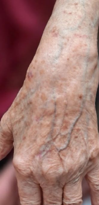 Depois: a mesma mão após uma sessão de peeling químico.